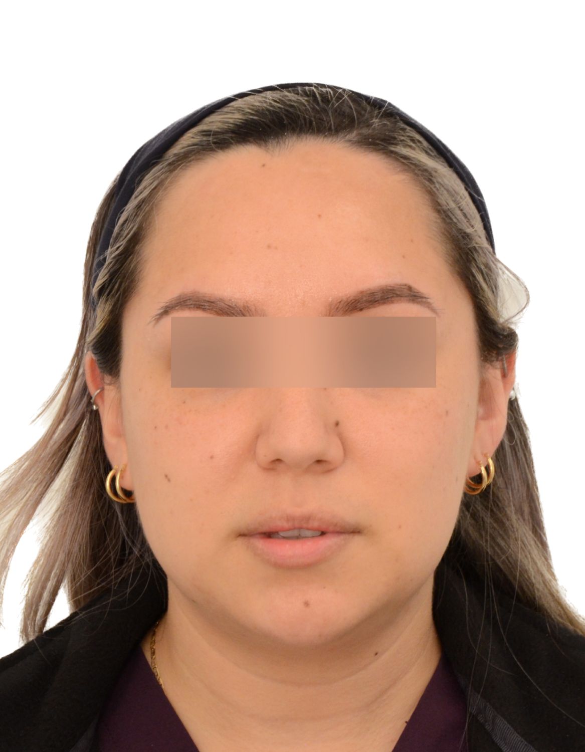 Forehead Reduction Surgery Before