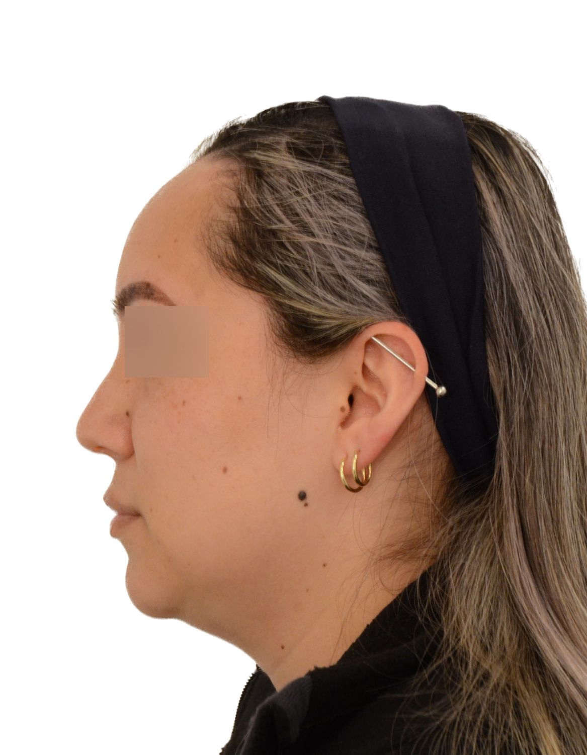 Forehead Reduction Surgery Before