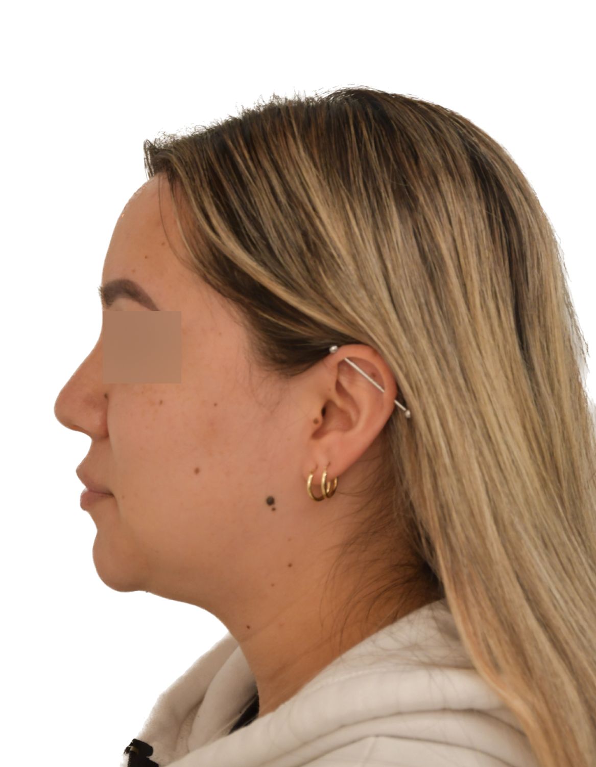 Forehead Reduction Surgery After