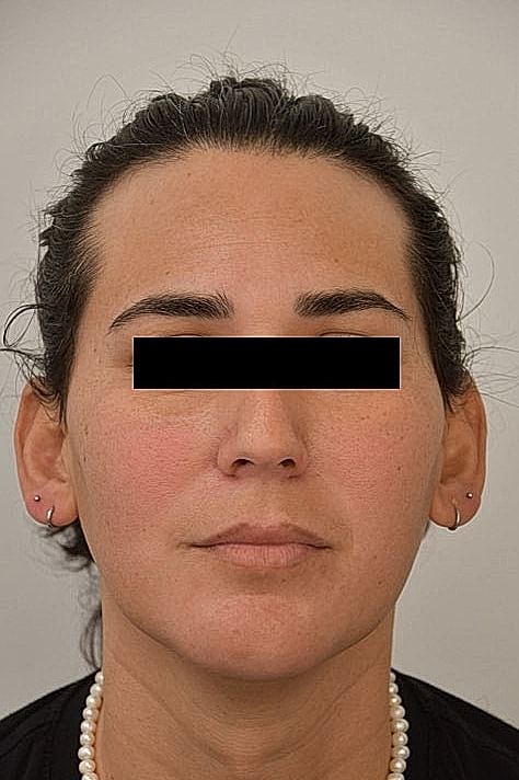 Facial Feminization Before & After