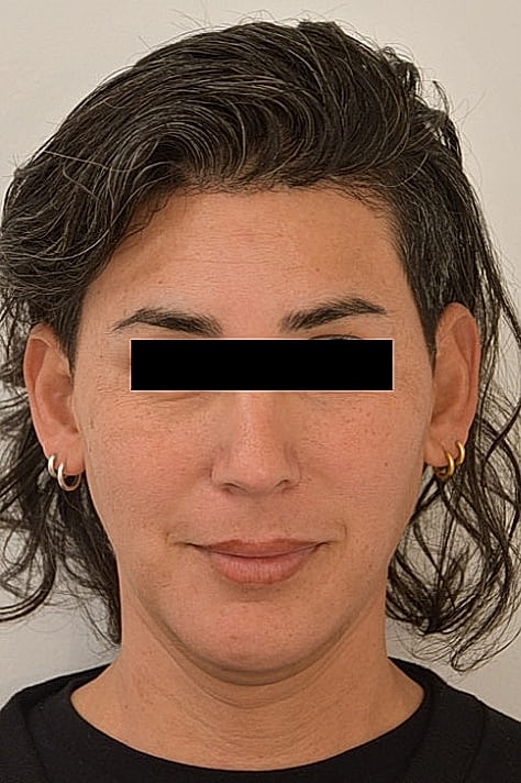Facial Feminization Before & After
