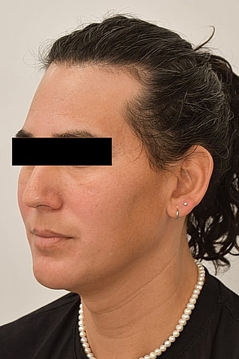 Facial Feminization Before & After