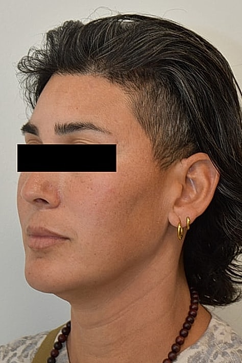 Facial Feminization Before & After