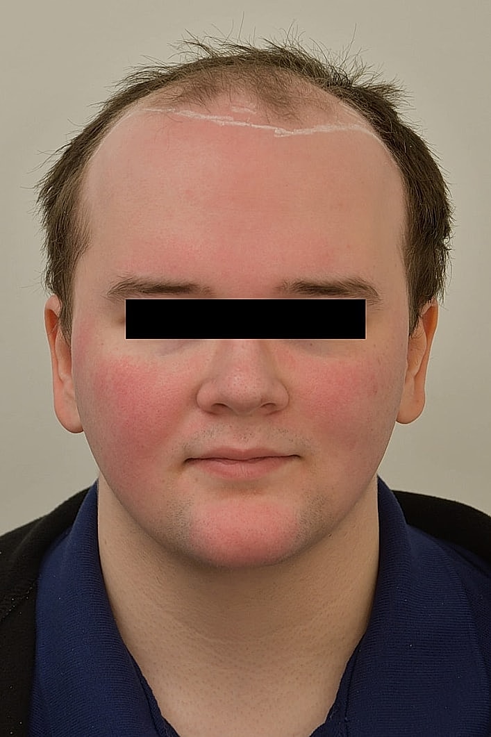 Facial Feminization Before & After