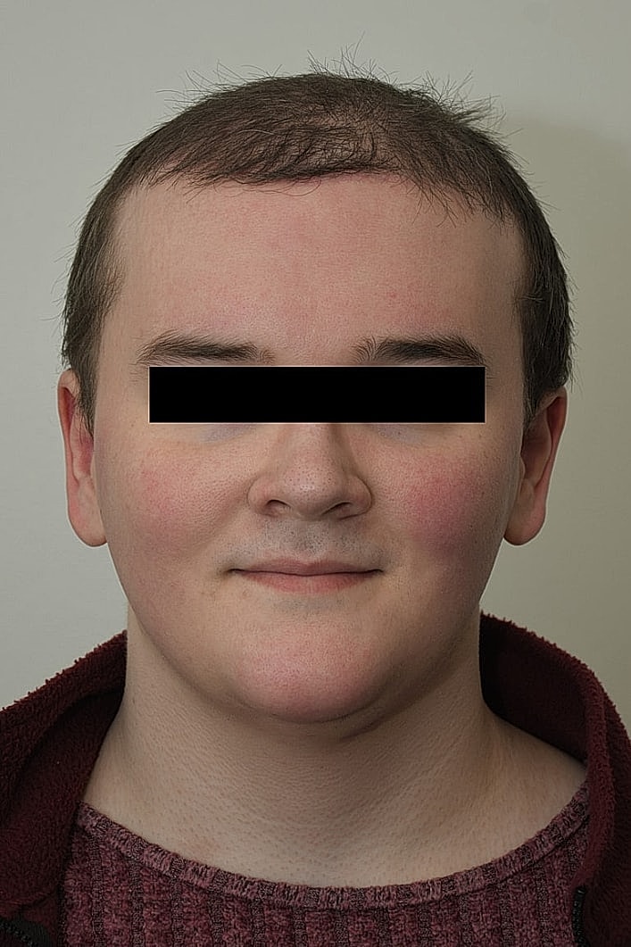 Facial Feminization Before & After