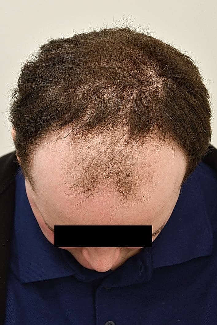 Facial Feminization Before & After