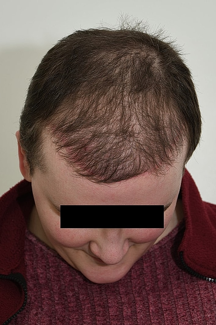 Facial Feminization Before & After