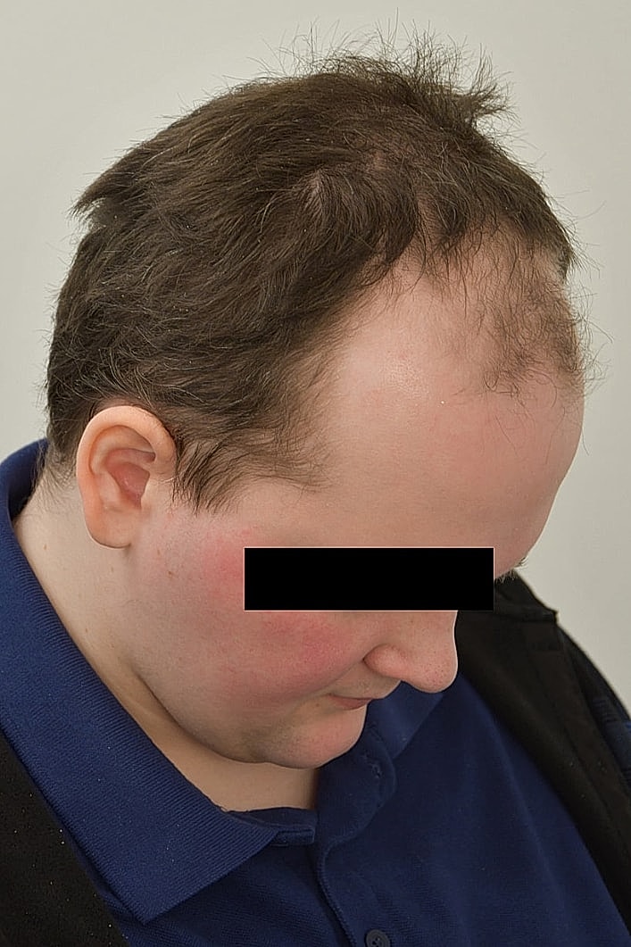 Facial Feminization Before & After