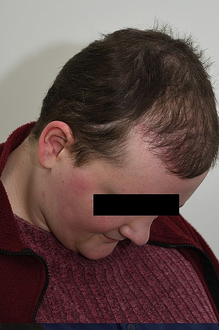 Facial Feminization Before & After