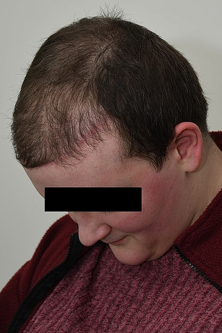 Facial Feminization Before & After