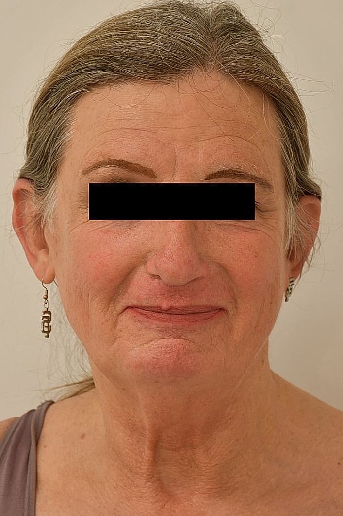 Facial Feminization Before & After