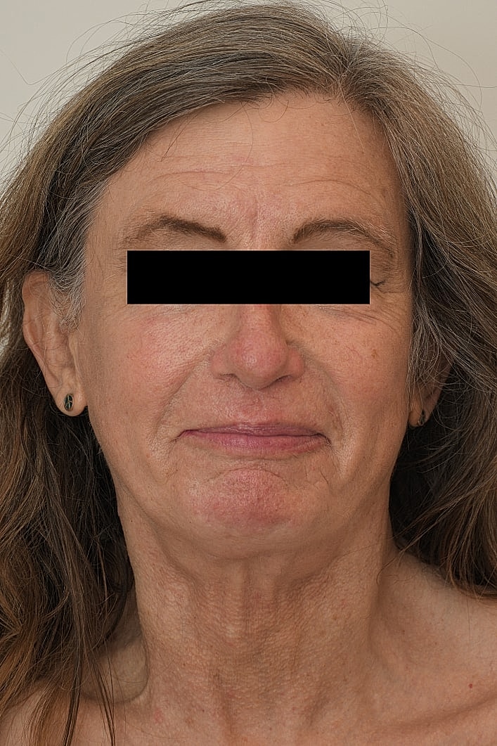 Facial Feminization Before & After