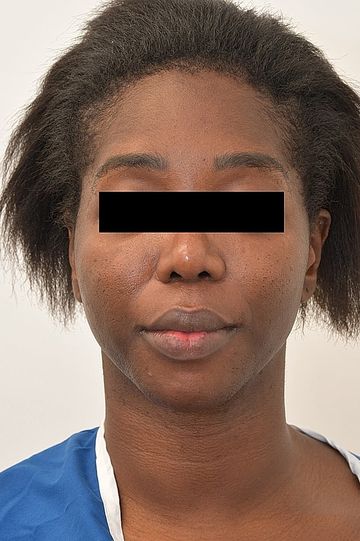 Facial Feminization Before & After